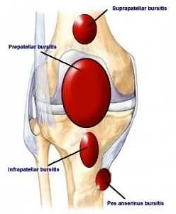 Causes of Knee Bursitis