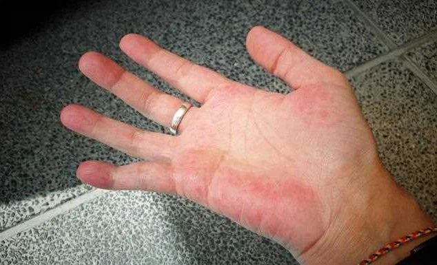 Swollen Palms