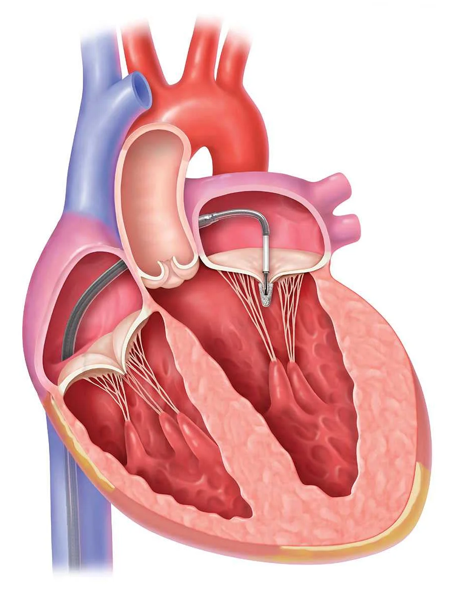 Diagnosis of Mitral regurgitation