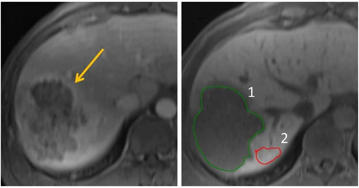 Understanding MRI