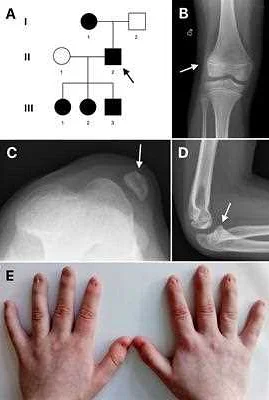 Diagnosing Nail-Patella Syndrome