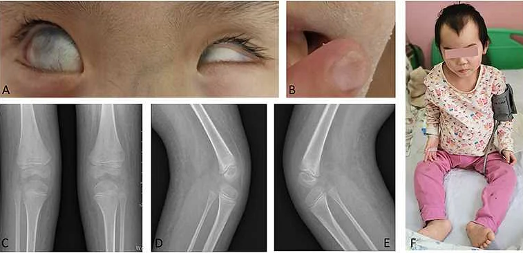 Understanding the Causes of Nail-Patella Syndrome