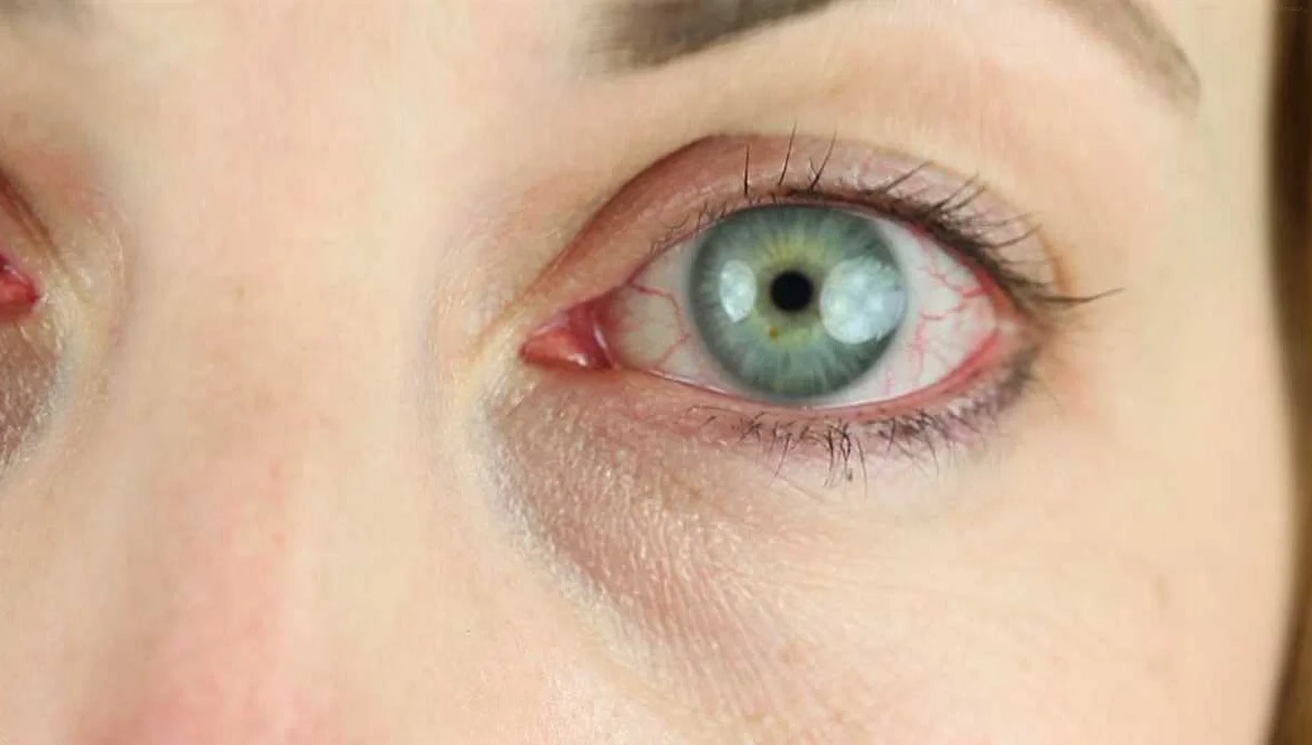 Causes of Conjunctivitis: Allergies, Infections, and Irritants