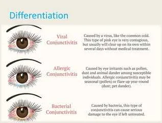 Diagnostic Methods for Conjunctivitis: Tests and Examinations