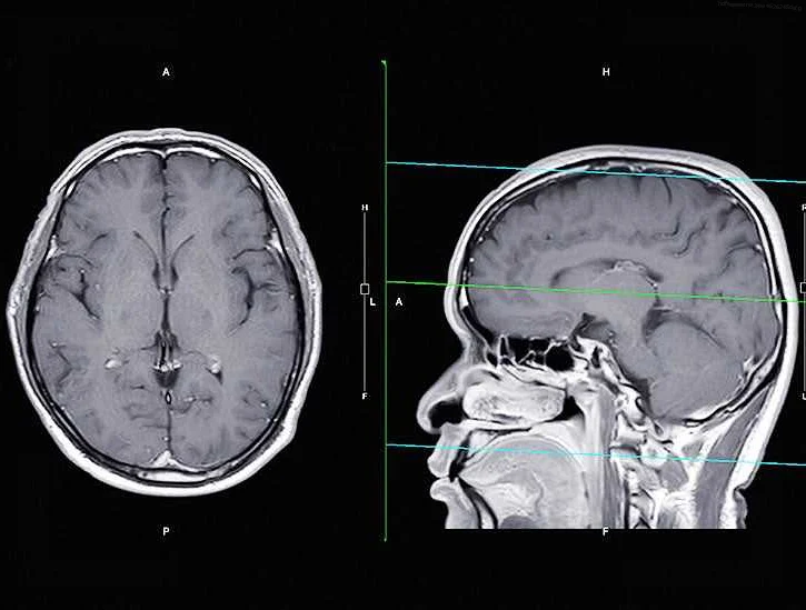 Pituitary Adenoma of the Brain: An Overview