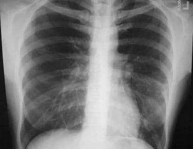 Treatment Options for Polysegmental Pneumonia