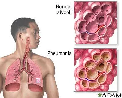 Polysegmental Pneumonia in Adults