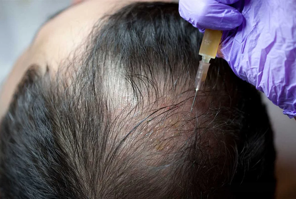 Tips for Combating Postpartum Hair Loss