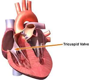 What is Tricuspid Valve Regurgitation?