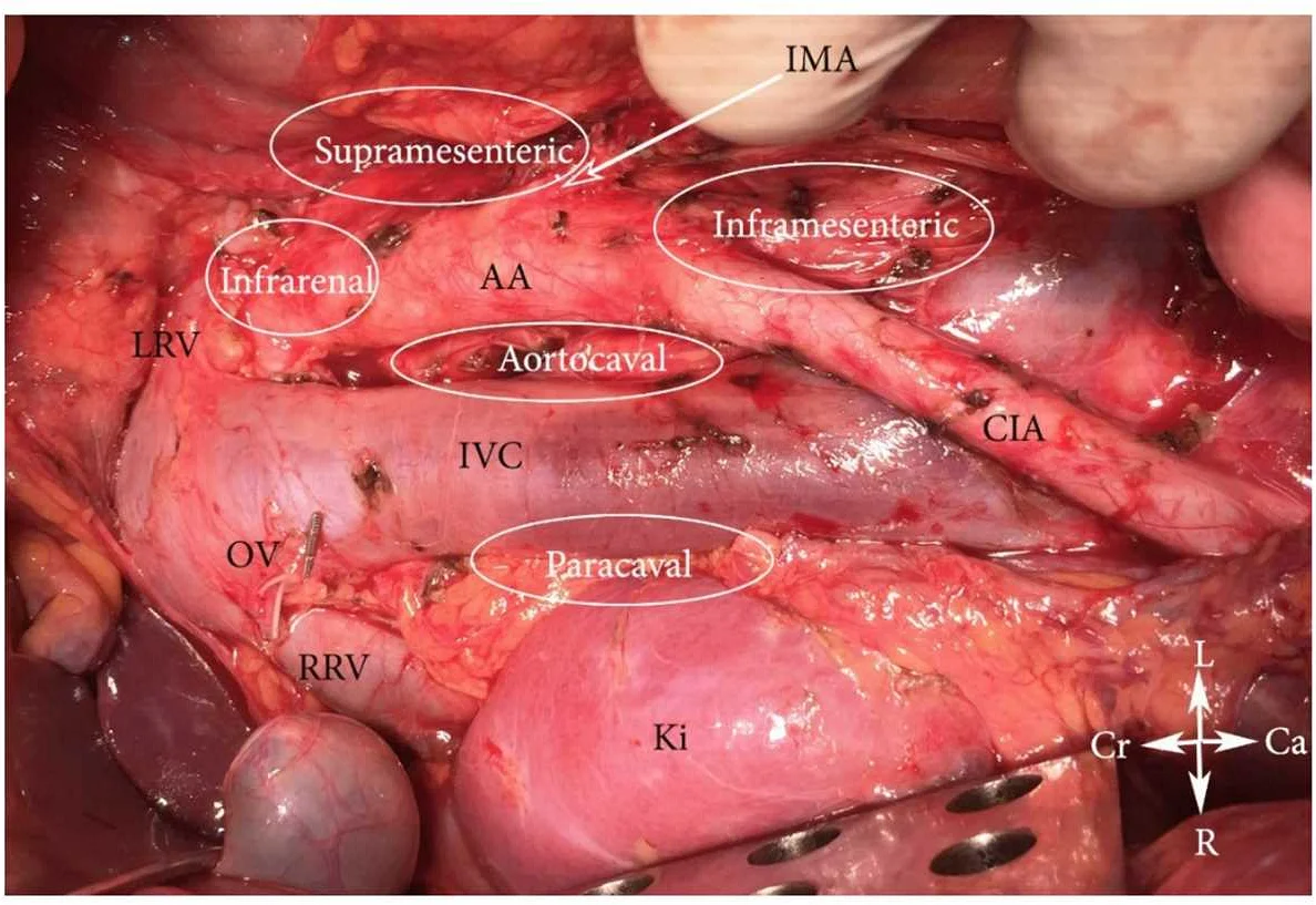 What are Thrombosed Nodes?