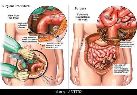 What is Salpingoophoritis?