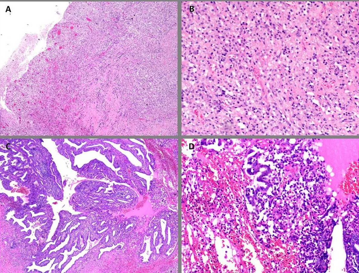 Treatment Options for Salpingoophoritis