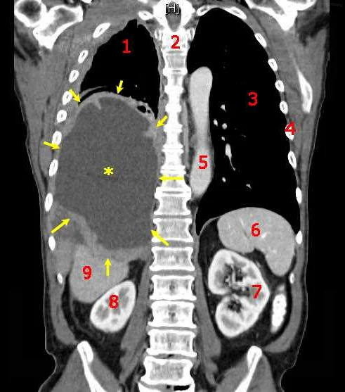 Lung Cancer: Higher Rates in Men