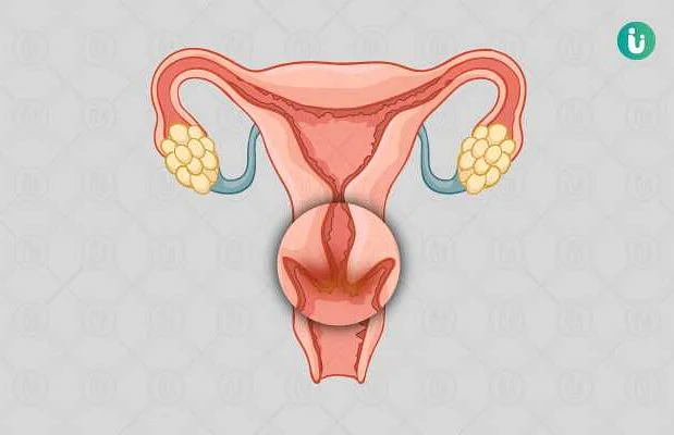 What Is Cervicitis?