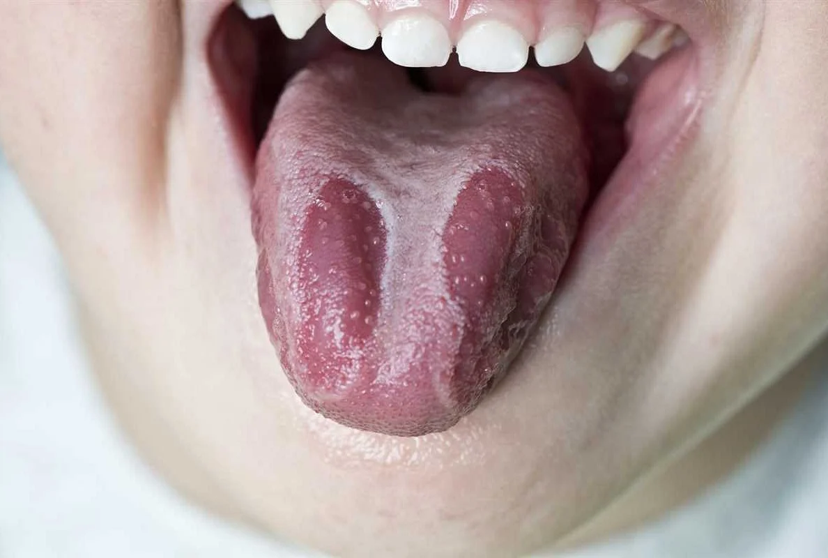 Diagnosing Tongue Spots