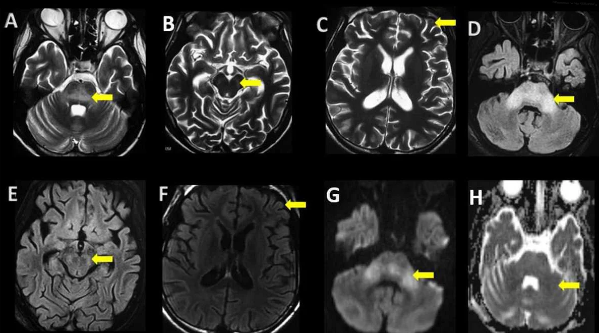 Diagnosis and Prognosis of Subacute Sclerosing Panencephalitis