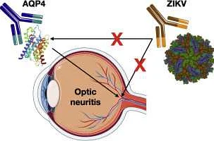 Overview of Neuromyelitis Optica