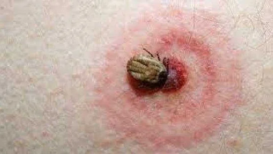 Health risks associated with tick bites