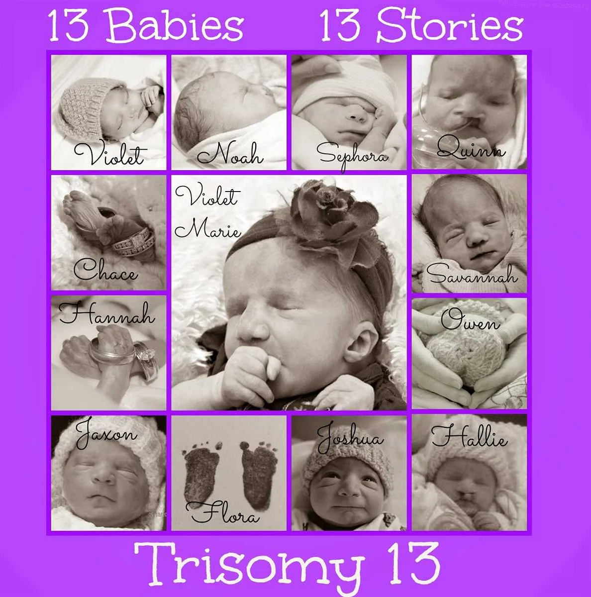 Symptoms of Trisomy 13