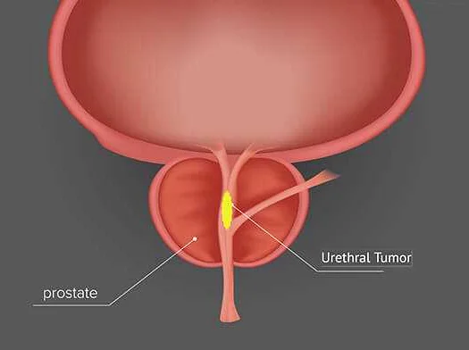 Urethral Cancer