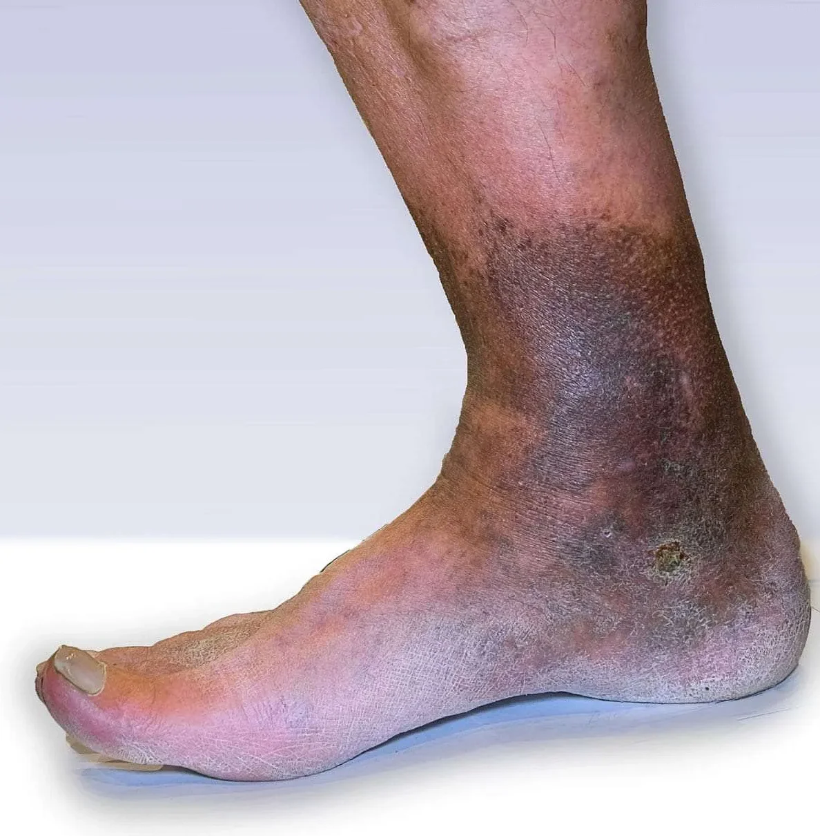 Understanding Venous Insufficiency