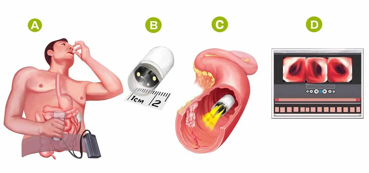 When is video capsule endoscopy used?