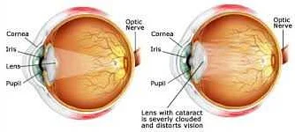 Common Symptoms of Cataracts