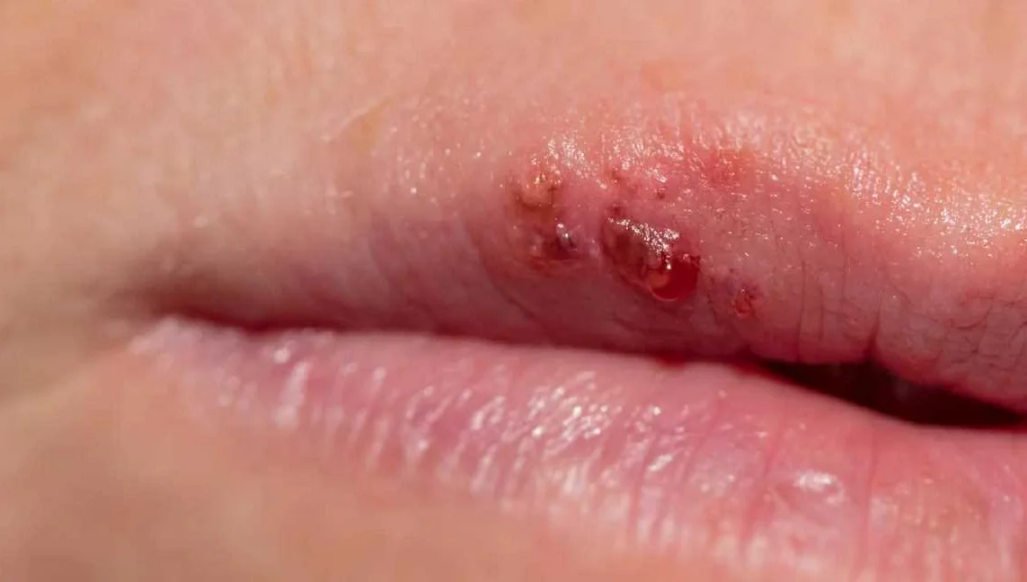 What are lip rashes?