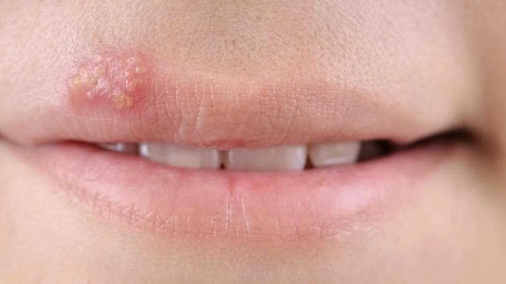 Common diseases causing rashes on the lips