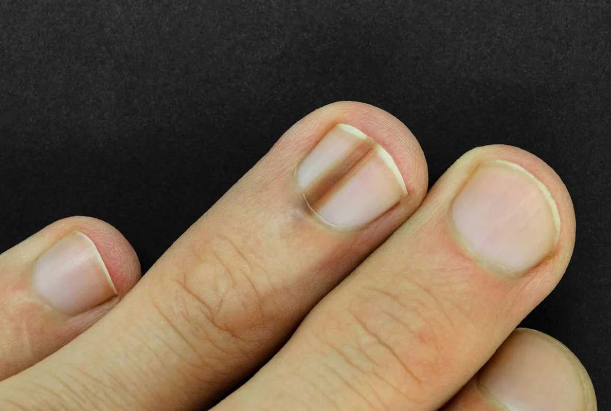 Pale Nails: Possible Indication of Anemia or Malnutrition