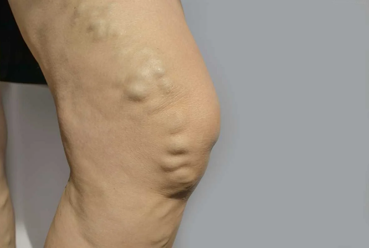 Causes of Vaginal Varicose Veins