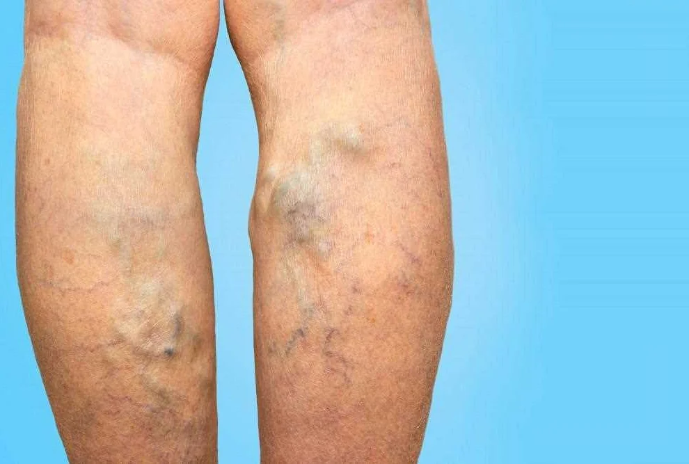 Treatment Options for Vaginal Varicose Veins