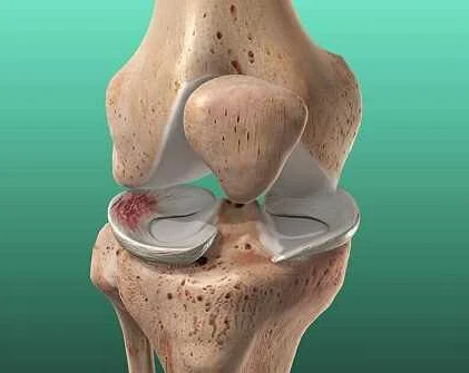 Common Causes of Knee Pain during Squats